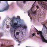 Περιπυρηνική άλω, κολπίτις βακτ. αιτιολογιας